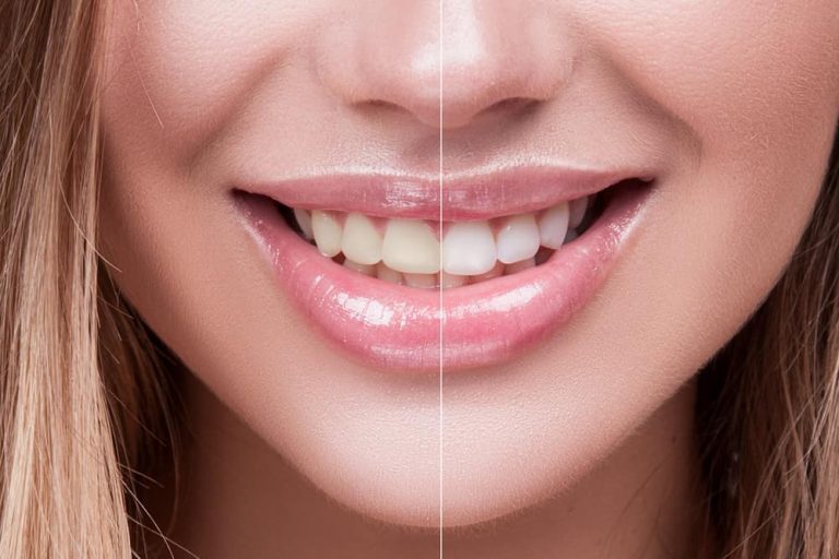 Why teeth whitening in Dubai is gaining popularity