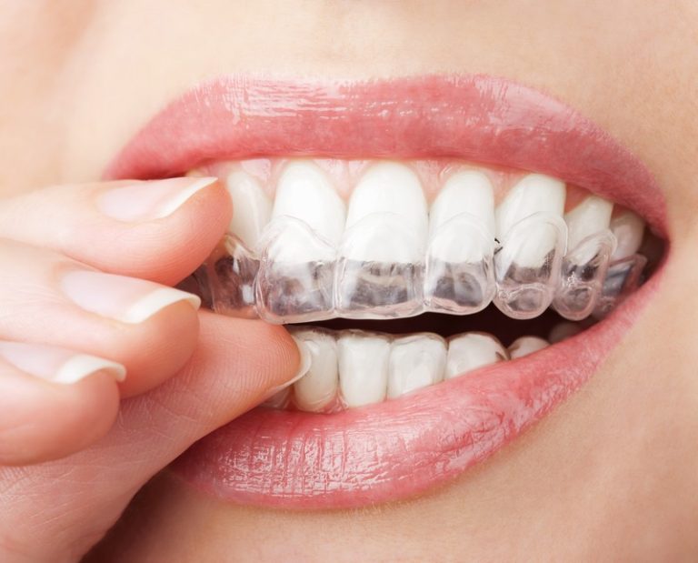 <strong>How many people are in Treatment with the Invisalign System?</strong>